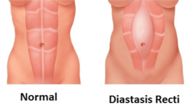 Diastasis Abdominal - Clínicas Aleria